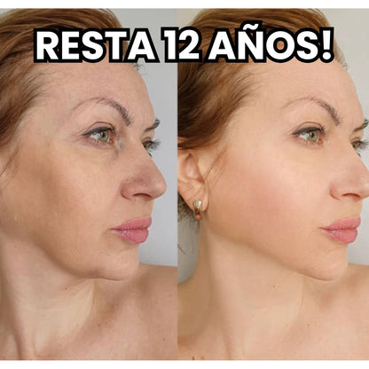 GLOWLAB MICROINFUSION ® - CON ÁCIDO HIALURONICO