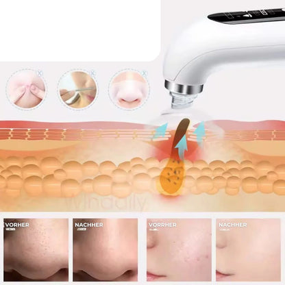 LipFace ® - EFICIENTE EXTRACTOR DE ESPINILLAS ANTI-MALTRATO DE LA PIEL