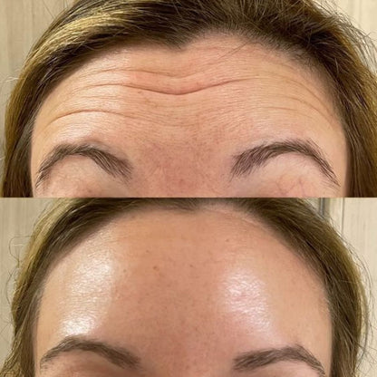 GLOWLAB MICROINFUSION ® - CON ÁCIDO HIALURONICO