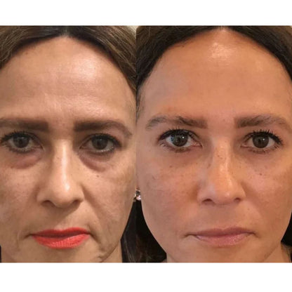 GLOWLAB MICROINFUSION ® - CON ÁCIDO HIALURONICO
